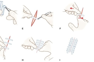 Các mũi khâu cơ bản trong phẫu thuật, khâu vết thương