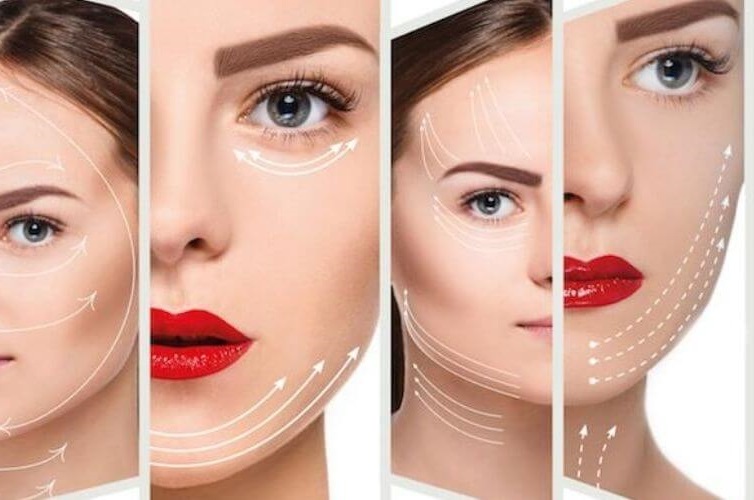 Cấy chỉ thẩm mỹ